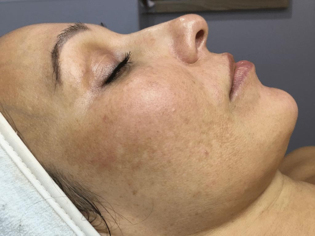 TheBeautySkinCo_Results_Stella-Before