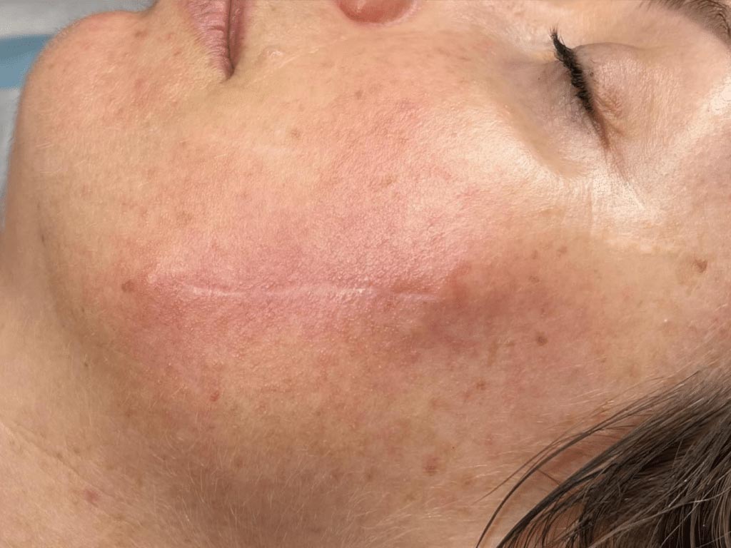 TheBeautySkinCo_Results_SurgicalScarring-After