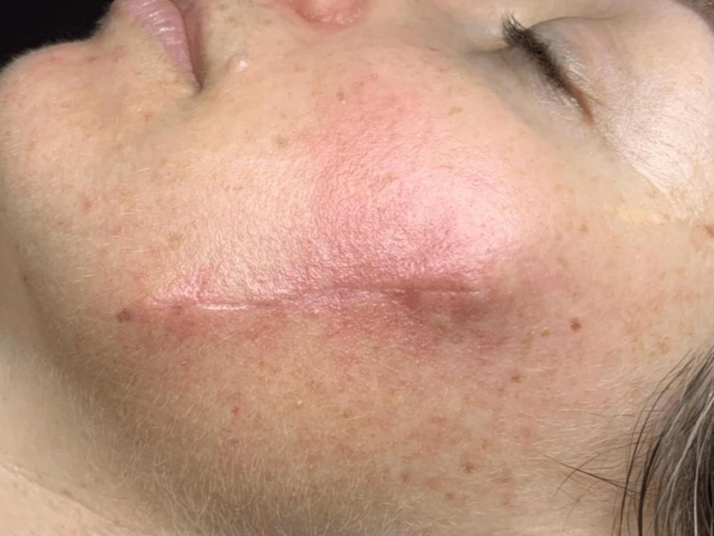 TheBeautySkinCo_Results_SurgicalScarring-Before